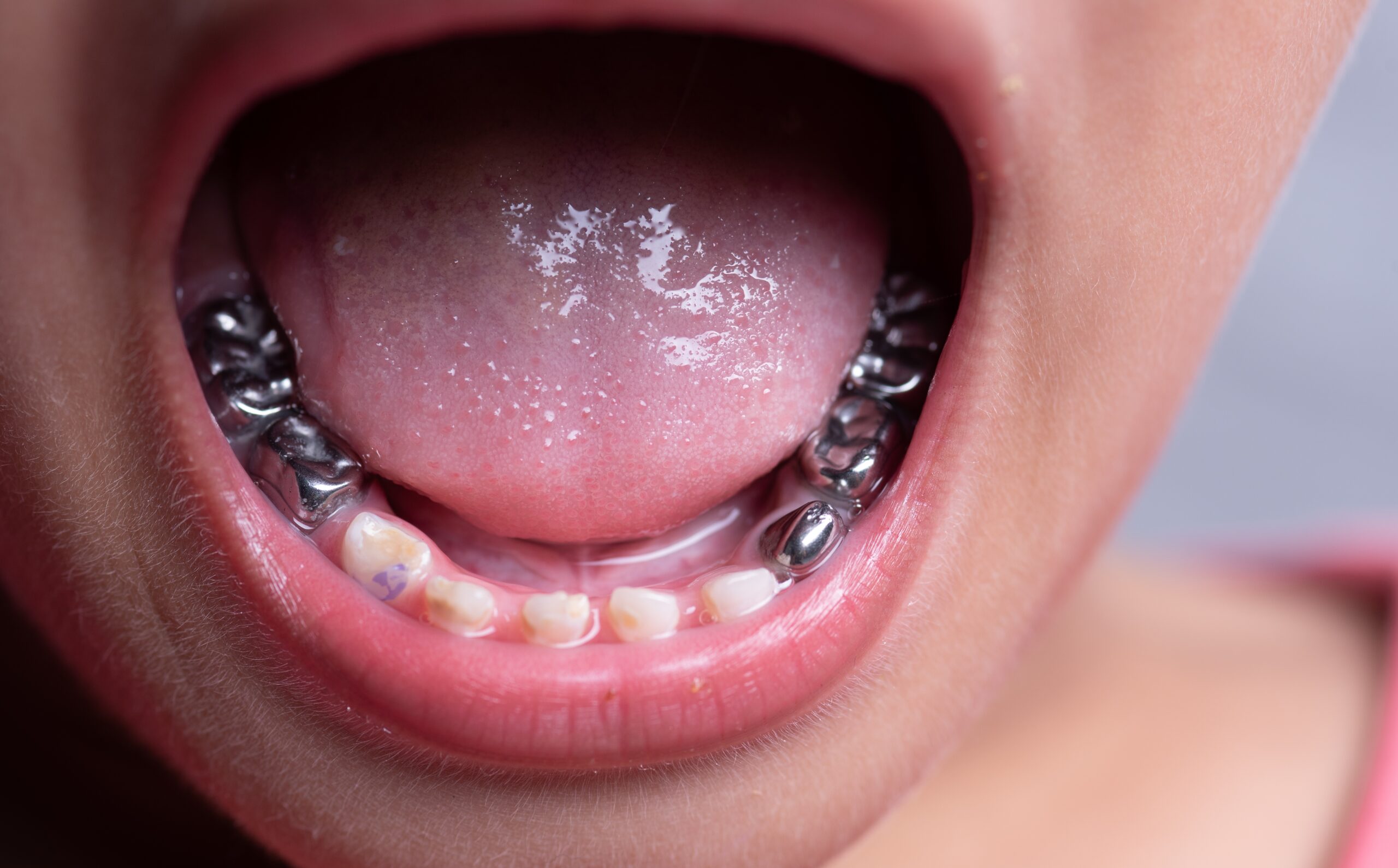 Amalgam Fillings Dardenne